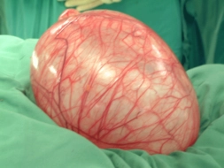 Yumurtalıkta Kist Belirtileri ve Tedavisi